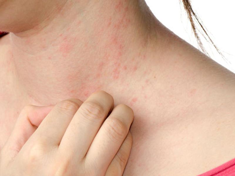Yaz mövsümündə allergiyadan necə qorunmalı? - AÇIQLAMA